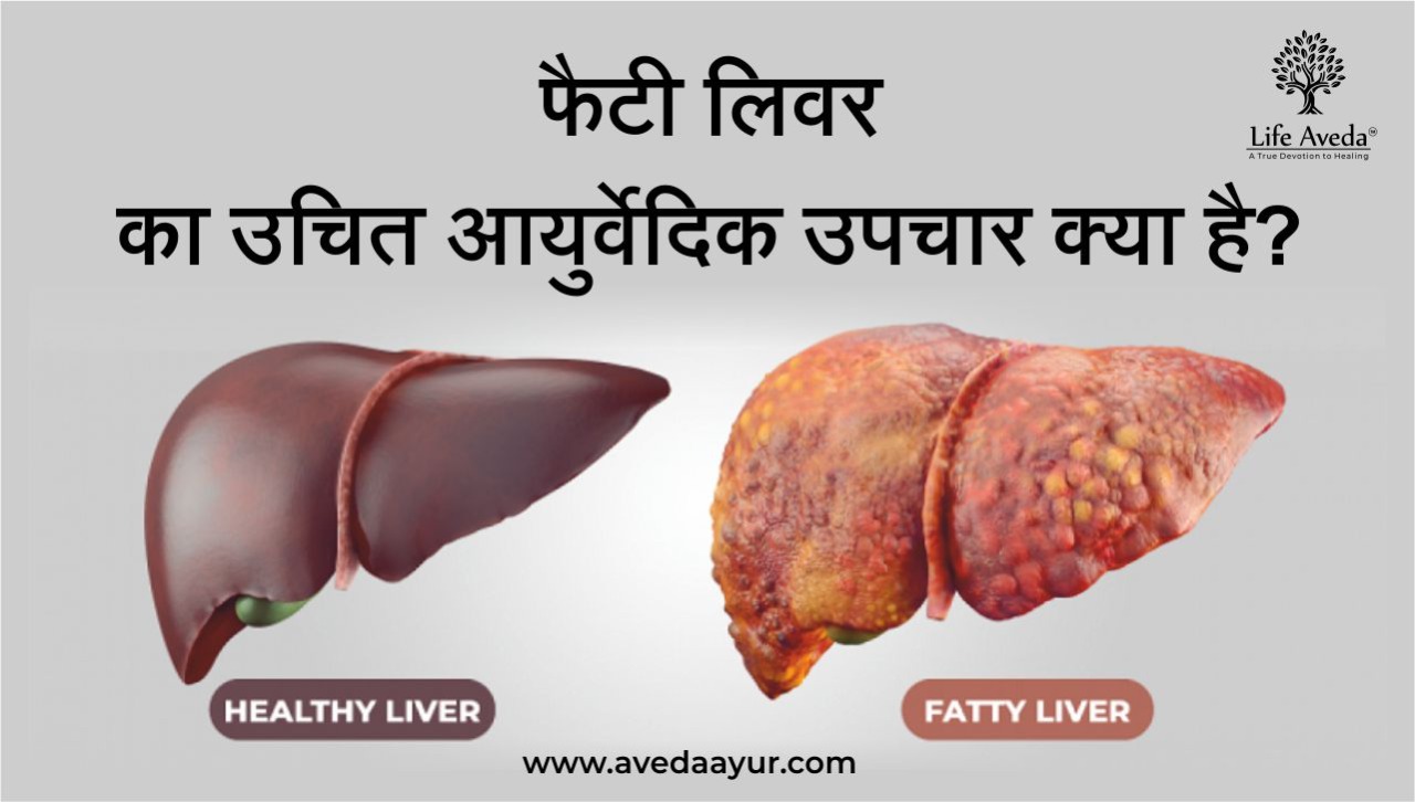 वर का आयुर्वेदिक उपचार: Ayurvedic Treatment of Fatty liver in hindi
